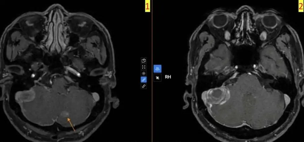 Hình ảnh tổn thương gợi ý ung thư di căn não trên hình ảnh phim chụp MRI sọ não. Ảnh: Bệnh viện cung cấp