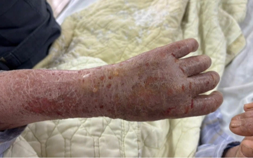 Người phụ nữ bị ngứa dữ dội đến mức “ảo giác có sâu bò”: Nguyên nhân gây sốc từ thói quen nhiều người Việt vẫn làm