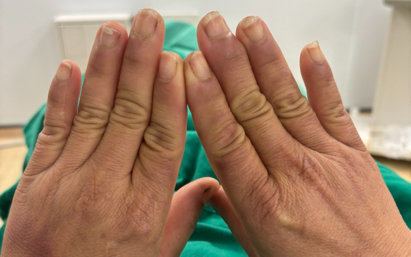 Căn bệnh lạ khiến người phụ nữ đau đớn mỗi khi chạm tay vào nước