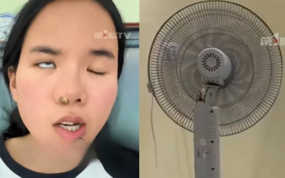 Cô gái bị liệt mặt vì bật quạt máy ngủ trưa, bác sĩ đưa ra lời cảnh báo