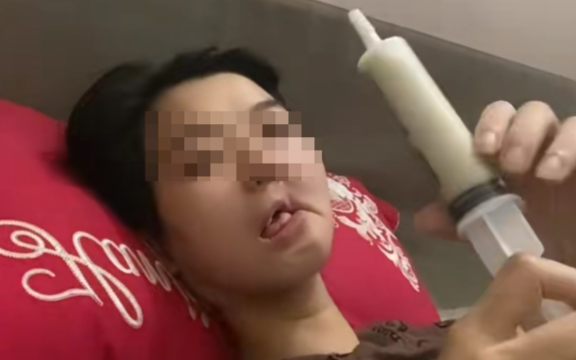 Hình ảnh cô gái mắc UT xương hàm, bữa ăn hàng ngày là "cháo xay loãng ăn bằng xi lanh" gây xót xa: Dấu hiệu phát hiện bệnh sớm trước khi quá muộn