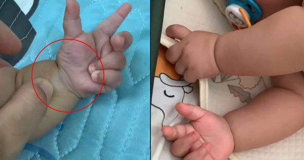 Thấy bàn tay bụ bẫm của con có 1 "chi tiết lạ", mẹ Việt lên mạng mới biết con có "dấu hiệu dị tật", cần đến khám bác sĩ Nhi gấp