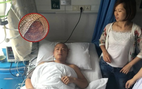 Ruột của người đàn ông lốm đốm như 