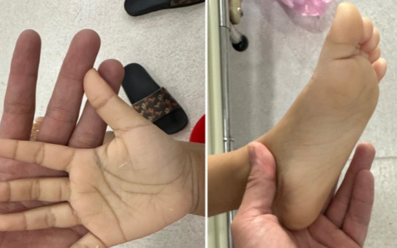 Bé gái da xanh, tay vàng vì ngày nào cũng uống 2 lít sữa, nhìn cách mẹ đưa đi khám, bác sĩ càng thở dài