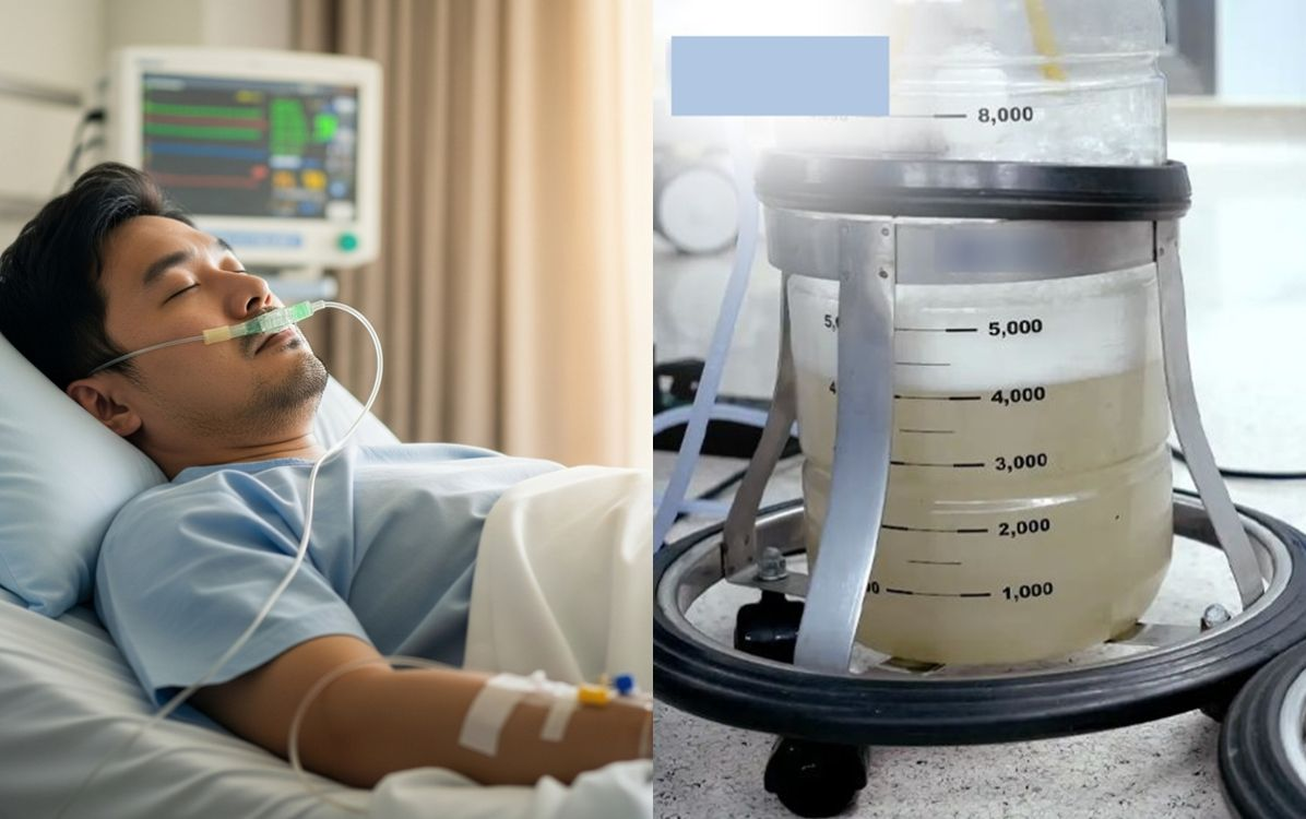 Hút 30 lít dịch đục như bùn từ phổi người đàn ông, nguyên nhân gây rùng mình