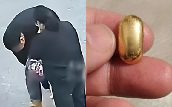 500.000 người theo dõi vụ cậu bé 11 tuổi nuốt nhầm miếng vàng 10g