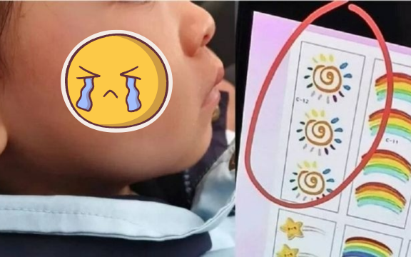 Dán sticker cho “đáng yêu hơn”, bé gái nhập viện với tổn thương da nghiêm trọng, phụ huynh bàng hoàng