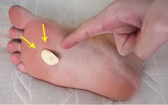 Người phụ nữ 56 tuổi dán tỏi vào lòng bàn chân suốt 6 tháng, kết quả khám sức khỏe khiến bác sĩ "ngã ngửa"