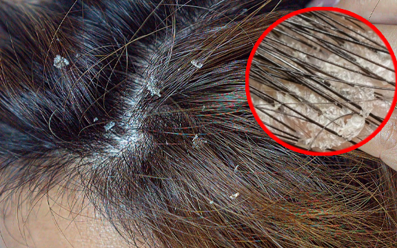 Bỏ qua là hối không kịp: dấu hiệu UT ng:uy h:iểm ai cũng nhầm là… GÀU