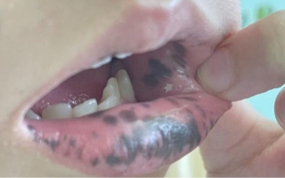 Mẹ phát hiện môi con gái 10 tuổi có nhiều đốm đen kỳ lạ, đến bệnh viện kiểm tra thì kinh hãi nghe bác sĩ nói