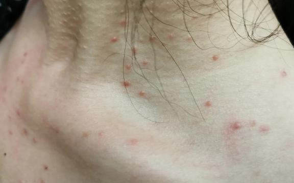 4 bất thường ở cổ cảnh báo sớm b:ệnh UT, chỉ mất 1 phút để tự kiểm tra