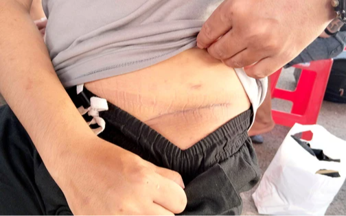 Nam thanh niên sang Campuchia làm “việc nhẹ lương cao” bị cưỡng ép cắt bỏ một quả thận: Vết sẹo dài bên mạn sườn gây ám ảnh