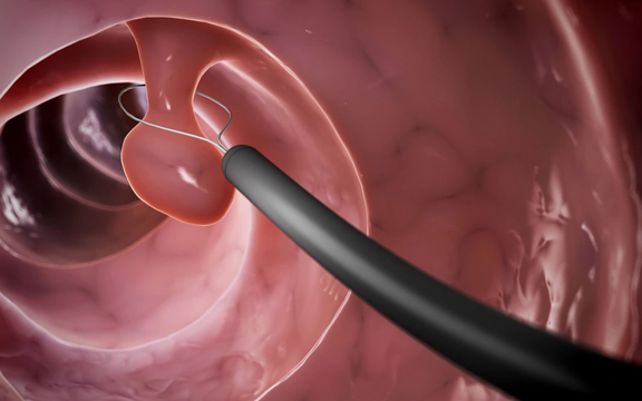 20 tuổi đã suýt bị ung thư đại tràng: Bác sĩ nói người trẻ có 4 dấu hiệu này khi đi vệ sinh phải đi khám gấp