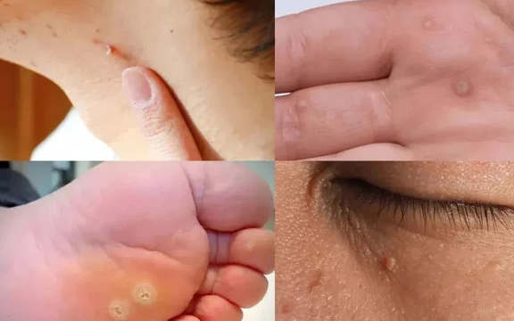 Cô gái 19 tuổi nhiễm cùng lúc 8 chủng HPV: Khi sự chủ quan của tuổi trẻ có thể phải trả giá bằng sức khỏe sinh sản