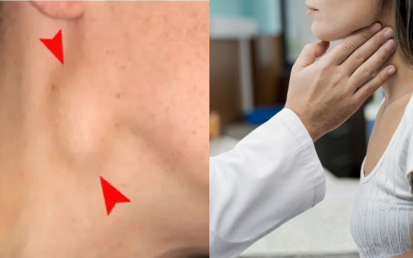 Tự sờ thấy hạch cổ, đi khám phát hiện ung thư phổi di căn