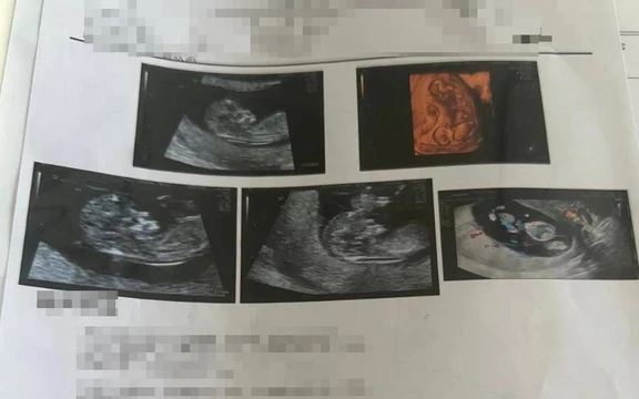 Đi khám thai 4 lần , người phụ nữ sốc nặng sau khi mỗi lần đều thấy kết quả siêu âm khác nhau