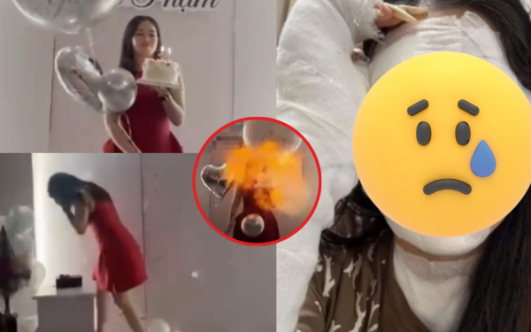 Tình trạng sức khỏe và diện mạo hiện tại của cô gái bị bỏng nặng do bóng bay sinh nhật phát nổ