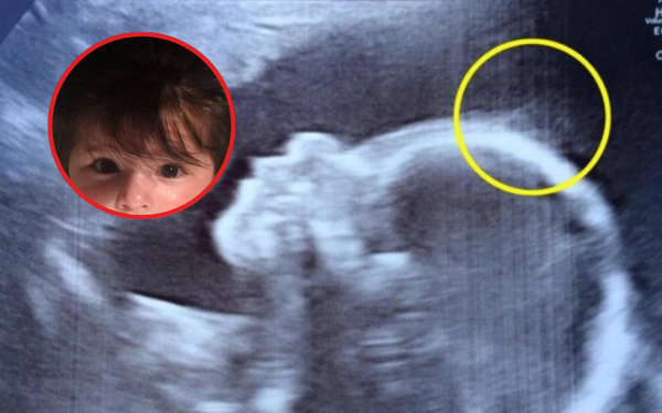 Đến viện siêu âm, mẹ bầu giật mình thấy điểm lạ trên đầu con, cái kết bé gái sinh ra đã nổi tiếng vì quá xinh
