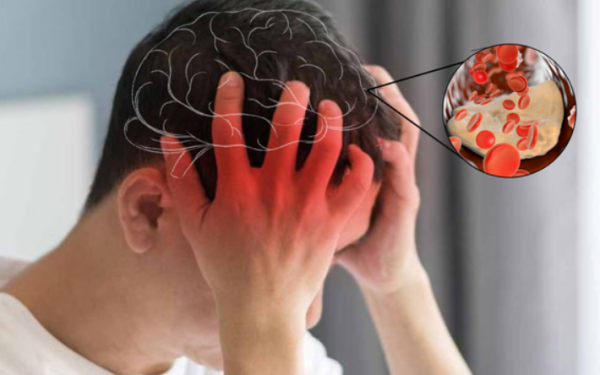 Đột quỵ tuổi 30, bác sĩ chỉ ra 4 dấu hiệu SOS rõ ràng nhất nhưng hay bị ngó lơ