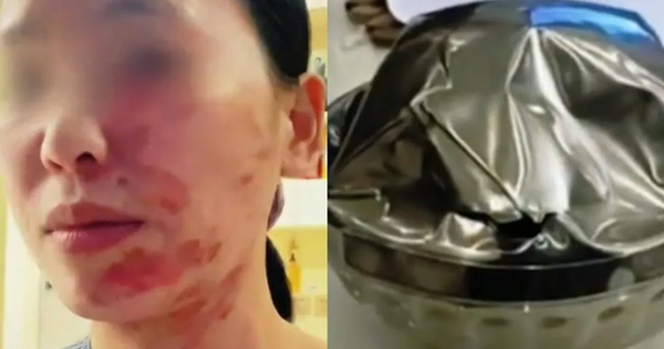 Chiếc bát bất ngờ phát nổ khiến người phụ nữ bỏng toàn thân: 3 loại bát nên cân nhắc khi đựng đồ nóng kẻo tự hại thân