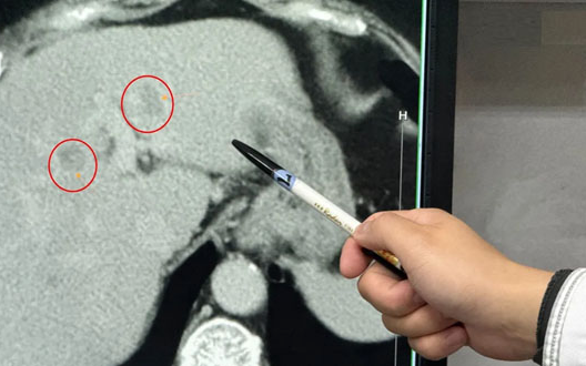 Người phụ nữ 60 tuổi mắc ung thư gan, một nửa gan là mỡ vì ngày nào cũng ăn 2 món "vạn người mê"