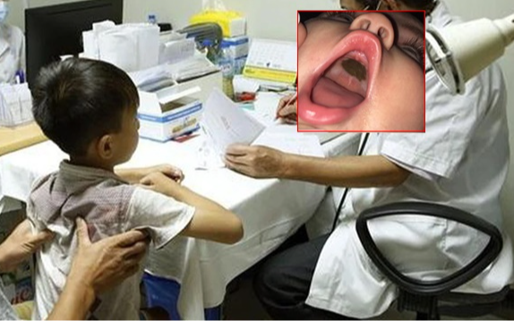 Mẹ phát hoảng thấy miệng con xuất hiện đốm đen lạ, đến bệnh viện nghe bác sĩ chúc mừng mà xấu hổ
