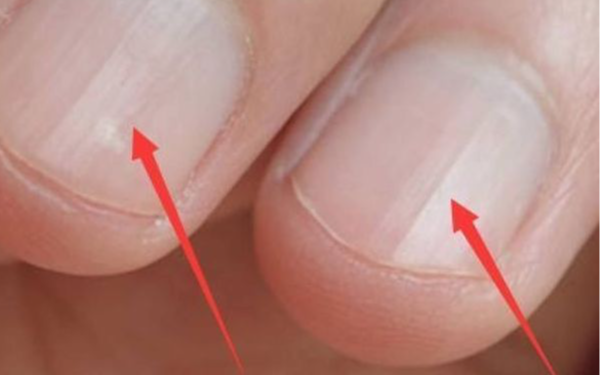 Bàn tay là tín hiệu cảnh báo sức khỏe: 1 thay đổi có thể cho thấy bệnh tiểu đường hoặc xơ gan