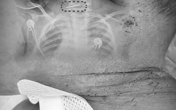 Chấn động vụ em bé 10 tháng tuổi nhập viện với 600 vết kim bị mẹ đâm để "chữa bệnh"