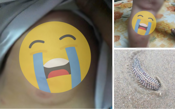 Bệnh viện lên tiếng về thông tin sâu biển cắn cháu bé nguy kịch, cần truyền máu gấp