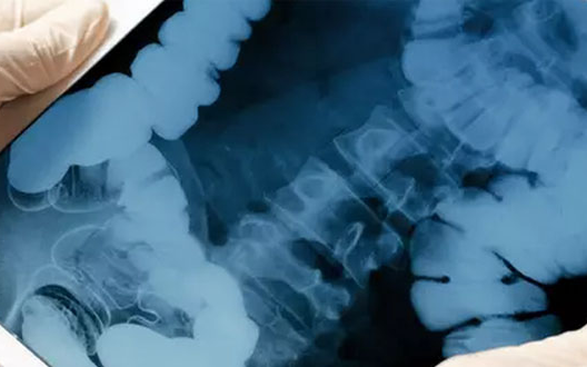 Bệnh viện n:áo l:oạn vì quả đ:ạn ph:áo Thế chiến I trong trực tràng bệnh nhân