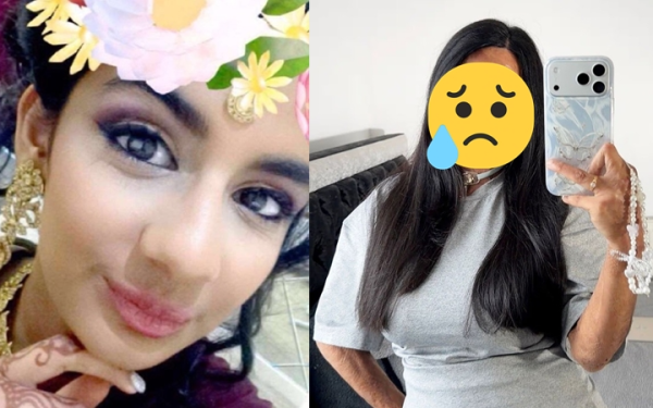 Dầu gội đầu trị chấy bắt lửa, thiếu nữ xinh đẹp bị bỏng nửa người và mất 7 ngón tay