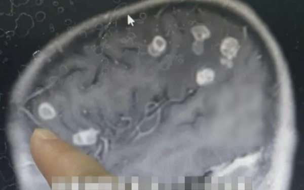 B:é gái 6 tuổi bị đục 20 lỗ ở não, suýt thành người thực vật: Bác sĩ cảnh báo 5 góc khuất chứa nhiều mầm bệnh phải cẩn trọng khi dọn nhà