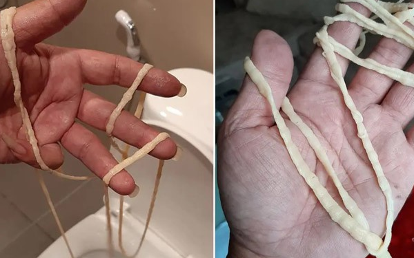 Người phụ nữ 32 tuổi không ăn đồ sống nhưng thải ra ký sinh trùng dài 3 mét: Bác sĩ chỉ ra 1 thói quen nấu ăn gây họa