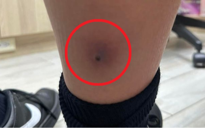 Tưởng chỉ là cúm mùa, bé trai 12 tuổi sốt trở lại: Bác sĩ vén ống quần kiểm tra liền yêu cầu cấp cứu khẩn cấp