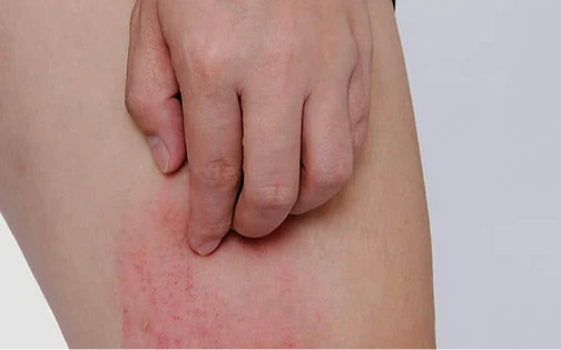 Hai bộ phận trên cơ thể ngứa ngáy là dấu hiệu của bệnh ung thư gan, nhiều người lại lầm tưởng là dị ứng