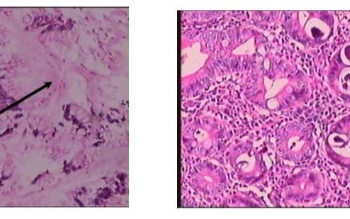 Bệnh viện 115 cảnh báo loại giun ký sinh trong ruột: Không triệu chứng, nhưng gây tử vong nếu uống sai thuốc kháng sinh