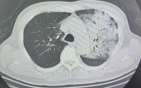 Người đàn ông sốt 40 độ C, phổi gần như "trắng xóa", chỉ vài ngày đã suy đa tạng: Thủ phạm liên quan đến thói quen nhiều gia đình vẫn mắc