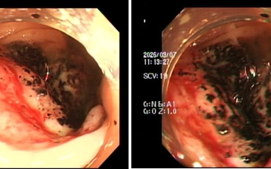 Ngày càng nhiều người trẻ bị ung thư đại trực tràng, Bệnh viện Nhân dân 115 đưa ra khuyến cáo KHẨN