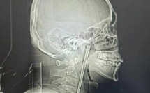 Người đàn ông sống 8 năm với chiếc đũa trong cổ họng dài 12cm và cái kết khiến cộng đồng mạng không thể tin nổi