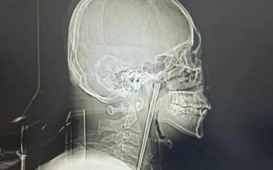 Người đàn ông sống 8 năm với chiếc đũa trong cổ họng dài 12cm và cái kết khiến cộng đồng mạng không thể tin nổi