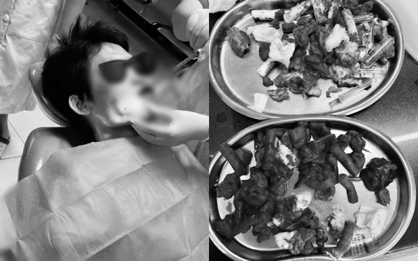 Lần đầu đi lấy cao răng bị chảy máu ồ ạt, bệnh nhân không ngờ bị ung thư máu