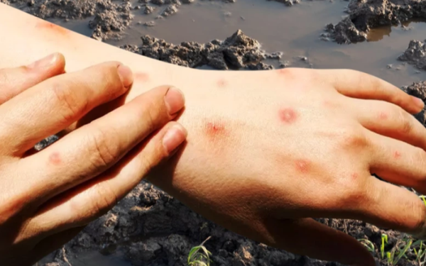 Thái Lan cảnh báo khẩn về dịch "sốt đất": 732 ca nhiễm, 23 trường hợp tử vong