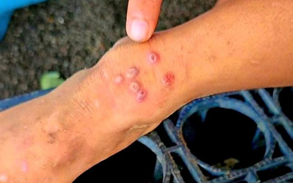 Thái Lan bật cảnh báo khi 23 người tử vong, 732 người bị lây nhiễm 1 căn bệnh, ở Việt Nam cũng đã xuất hiện