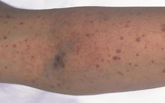 Phó giám đốc BV Bạch Mai cảnh báo căn bệnh diễn tiến nhanh, tàn phá thận