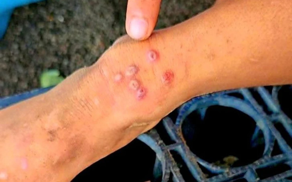 Thái Lan bật cảnh báo khi 23 người tử vong, 732 người bị lây nhiễm 1 căn bệnh, ở Việt Nam cũng đã xuất hiện