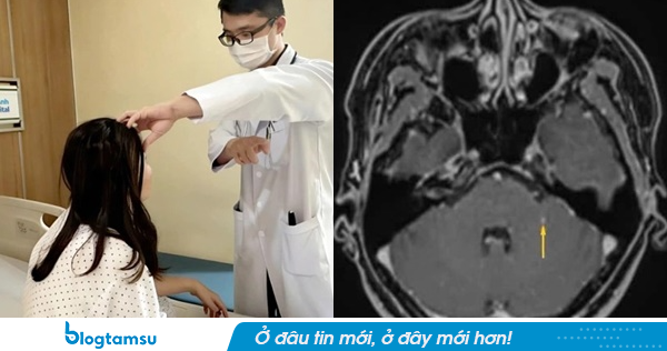 Giun ký sinh ở chuột tấn công não người phụ nữ