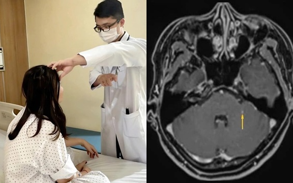 Giun ký sinh ở chuột tấn công não người phụ nữ