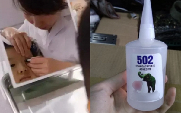 Cậu bé bắt chước bà nhưng nhỏ nhầm keo 502 vào mắt: Mẹ sơ cứu trong 15 phút, bác sĩ nói "không cần điều trị nữa"