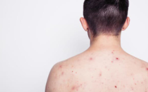 Nam thanh niên 23 tuổi nhiễm HIV sau khi tham gia lễ hội té nước tại Thái Lan