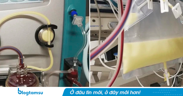 Bé gái 12 tuổi cấp cứu trong tình trạng máu trắng đục, nhớt như mỡ lợn, bác sĩ trách bố mẹ: Chiều kiểu hại con!